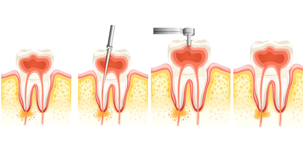 endodoncia-clinica-dental-gil-castellon-0-1