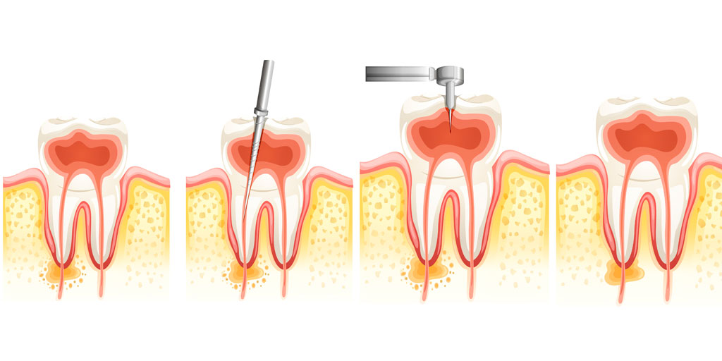 endodoncia-clinica-dental-gil-castellon-0 endodoncia-clinica-dental-gil-castellon-0-1