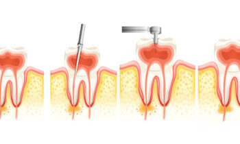 endodoncia-clinica-dental-gil-castellon-0