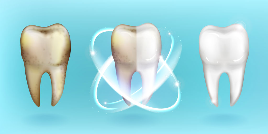 foto-0-blanqueamiento-dental-clinica-dental-gil-castellon-1 foto-0-blanqueamiento-dental-clinica-dental-gil-castellon-1