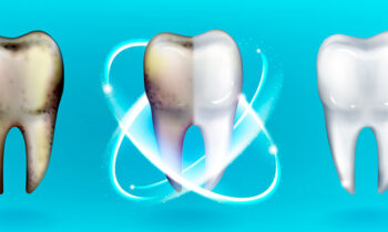 foto-0-blanqueamiento-dental-clinica-dental-gil-castellon