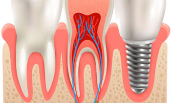 foto-00-implantes-dentales-clinica-dental-gil-castellon