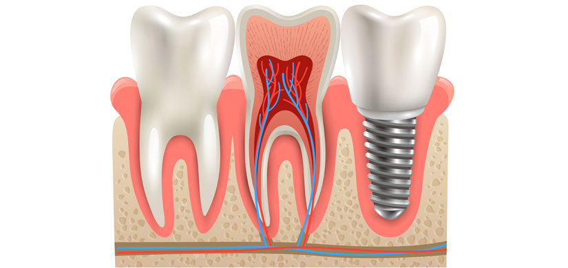 foto-01-slider-implantes-dentales-clinica-dental-gil-castellon foto-02-slider-implantes-dentales-clinica-dental-gil-castellon