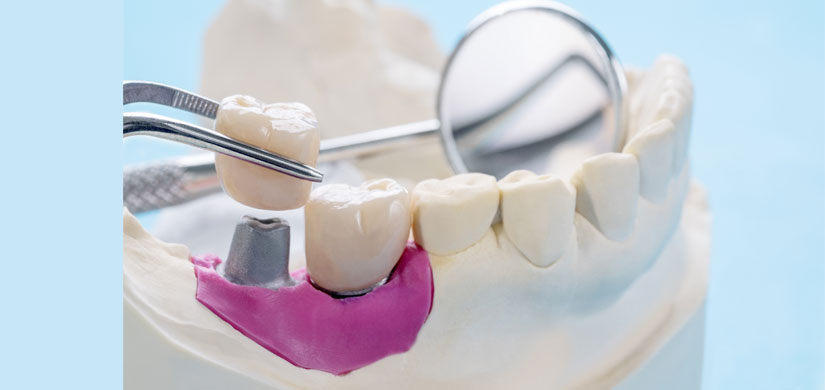foto-02-slider-implantes-dentales-clinica-dental-gil-castellon