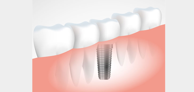 foto-03-slider-implantes-dentales-clinica-dental-gil-castellon