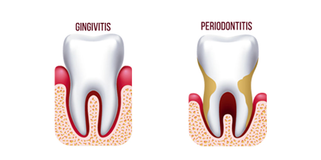 gingivitis-periodontitis-clinica-dental-gil-castellon-0 gingivitis-periodontitis-clinica-dental-gil-castellon-0-1