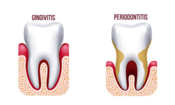 gingivitis-periodontitis-clinica-dental-gil-castellon-0