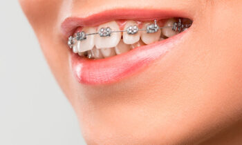 ortodoncia-clasica-clinica-dental-gil-castellon-0