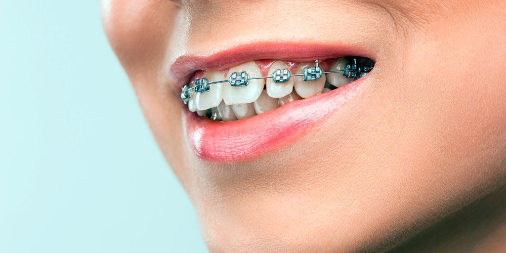 ortodoncia-clasica-clinica-dental-gil-castellon-1 ortodoncia-clasica-clinica-dental-gil-castellon-1