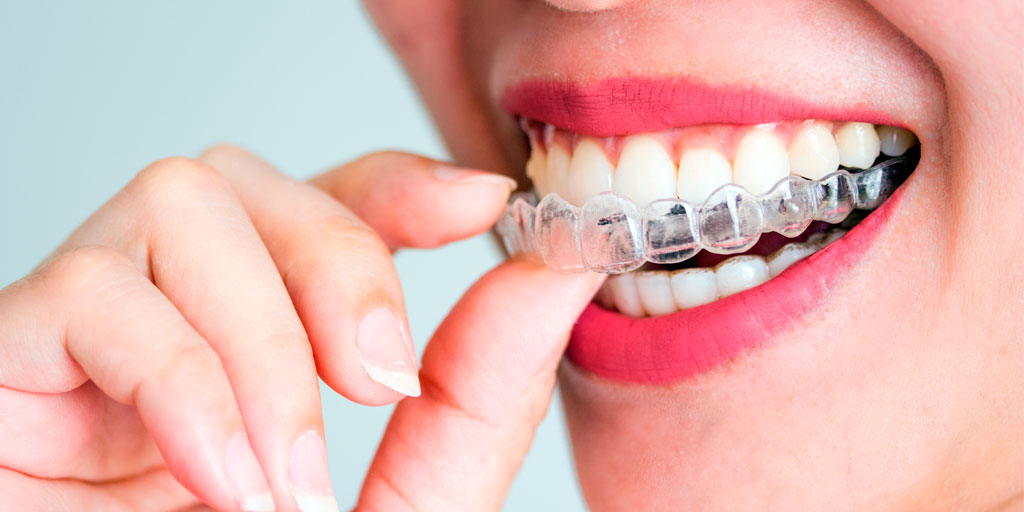 ortodoncia-invisible-clinica-dental-gil-castellon-1 ortodoncia-invisible-clinica-dental-gil-castellon-1
